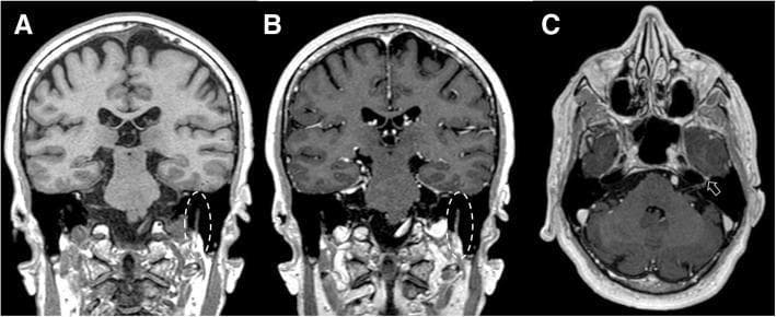 This set of diagnostic MRI images illustrates a clinical case of Bell’s palsy (idiopathic facial palsy). The figure comprises three panels: (a) and (b) are T1-weighted coronal views, while (c) is a T1-weighted axial view. Panels (a) and (b) provide a side-by-side comparison of the left facial nerve pre- and post-gadolinium administration. In the pre-contrast image (a), the nerve within the dotted circle displays normal dimensions and signal intensity. In the post-contrast image (b), the same region exhibits marked contrast enhancement and focal swelling, characteristic of inflammation and blood-nerve barrier disruption. Panel (c) is a post-contrast axial slice showing linear enhancement extending along the facial canal toward the geniculate ganglion (indicated by the arrow), which is located within the petrous portion of the temporal bone. These findings represent the typical radiological manifestation of Bell's palsy, distinguishing it from neoplastic processes by the absence of nodularity. The images serve as an educational resource for identifying cranial nerve VII pathology, relevant for neurology, neuroradiology, and emergency medicine specialties.