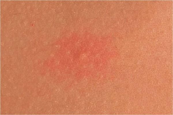 This clinical photograph shows a close-up view of a localized skin lesion on the torso, characteristic of a wheal. The central lesion is a well-circumscribed, erythematous (reddish) patch with a slightly raised, edematous surface compared to the surrounding unaffected skin. The morphology is roughly circular with moderate border definition. The affected area exhibits a subtly uneven texture, contrasting with the smooth, uniform skin tone and fine dermatoglyphic patterns (skin lines) of the adjacent healthy tissue. This image demonstrates the typical presentation of an urticarial lesion (hives), specifically illustrating the transient dermal edema and vascular dilation associated with aquagenic urticaria in an 18-year-old patient. Key educational concepts include morphology of primary skin lesions, recognition of erythematous wheals, and clinical manifestations of physical urticarias.