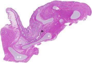 This diagnostic image is a low-magnification (1.25x) histological sagittal section of a human larynx stained with Hematoxylin and Eosin (H&E). The slide illustrates key upper airway anatomy, including the epiglottis, thyroid cartilage (marked with a single asterisk '*'), and the hyoid bone (marked with double asterisks '**'). The pathology demonstrated is tracheal agenesis, a rare congenital anomaly. The laryngeal lumen is seen terminating blindly, indicated by a black arrowhead (◀), rather than communicating with the trachea, which is absent from its expected anatomical position to the right of the larynx in this section. The cartilaginous structures appear as lighter, well-defined eosinophilic regions within the surrounding muscular and connective tissue. This image is clinically significant for neonatology and pediatric pathology as it provides visual evidence of Floyd Type I tracheal agenesis, highlighting the total disruption of the continuity between the larynx and the distal respiratory system.