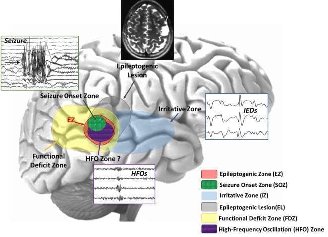 This medical infographic and anatomical diagram illustrates the conceptual and spatial relationships between various cortical zones used in the presurgical evaluation of epilepsy. Set against a lateral view of a human brain, the diagram highlights overlapping regions: the Seizure Onset Zone (SOZ, green), the High-Frequency Oscillation (HFO) zone (purple), and the Epileptogenic Zone (EZ, red outline). These are nested within the broader Functional Deficit Zone (FDZ, yellow) and the Irritative Zone (IZ, blue). The diagram also incorporates multimodal diagnostic data: a cranial MRI at the top showing an 'Epileptogenic Lesion' (EL); a 'Seizure' EEG tracing demonstrating ictal discharge associated with the SOZ; an 'IEDs' (Interictal Epileptiform Discharges) EEG strip corresponding to the IZ; and a localized EEG showing 'HFOs' above 80 Hz. This educational figure demonstrates how epileptologists integrate structural imaging, electrophysiology, and functional mapping to delineate the minimum amount of brain tissue requiring resection for seizure freedom while preserving eloquent cortex. The inclusion of the HFO zone represents modern advances in identifying biomarkers for the EZ.