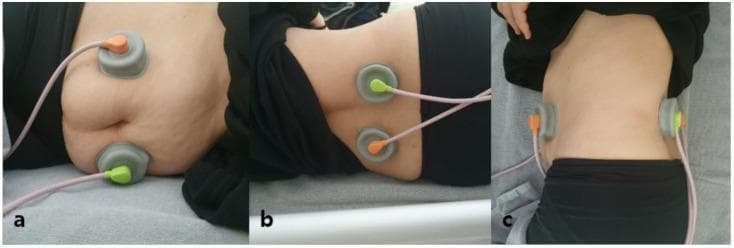 This composite of three clinical photographs illustrates the electrode placement for two-channel interferential current (IFC) therapy aimed at bowel stimulation. (a) Anterior view: Two circular grey electrodes with orange and green color-coded connectors are placed bilaterally on the anterior abdominal wall below the costal margin. (b) Posterior view: Two corresponding electrodes are positioned on the patient's back flanking the spine between the T12 and L4 vertebrae. (c) Lateral view: Provides a profile of the cross-sectional alignment, demonstrating how the electrodes are situated to create a crossing current path through the abdominal cavity. The patient is shown in a supine position on a medical table. Pink insulated wires connect each electrode to the IFC device. This procedural configuration is used in physical therapy and gastroenterology to modulate intestinal motility using a carrier frequency (e.g., 5 kHz) and beat frequency without inducing painful muscle contractions.