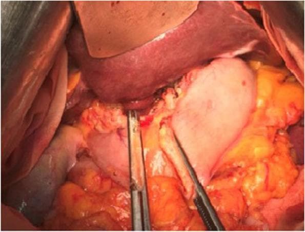 This clinical photograph shows an intraoperative open view of a surgical field during a Billroth I (B1) gastroduodenostomy, a common reconstruction technique following a distal subtotal gastrectomy. The liver is visible at the top of the field, retracted superiorly to provide access. Below the liver, the gastric stump is being prepared for anastomosis. Surgical clamps and forceps are seen manipulating the stomach and duodenal tissues to ensure proper alignment and tension-free connection. The surrounding area shows visceral fat (omentum) and evidence of surgical dissection, including minor hemostatic changes. The image illustrates the anatomical relationship between the gastric remnant and the duodenum in the upper abdomen. This visual is typical for educational materials focused on gastrointestinal surgical oncology, specifically the management of tumors located in the lower-third or antral segment of the stomach where distal resection is indicated.