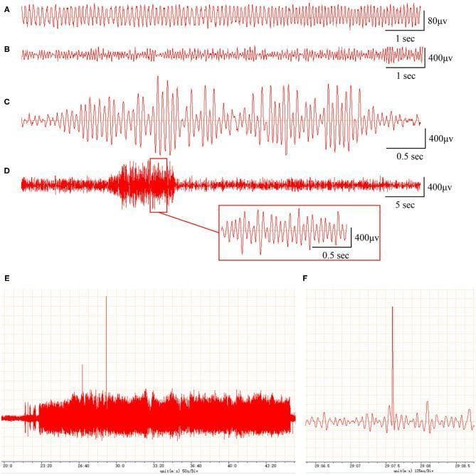 This diagnostic figure displays representative electroencephalogram (EEG) recordings demonstrating various epileptiform discharges in a model of post-traumatic epilepsy (PTE). Panel A shows a baseline normal EEG tracing characterized by regular oscillations with an amplitude of 80μV. Panels B through F illustrate diverse pathological waveforms associated with PTE: (B) multiple sharp-wave polyspikes with a 400μV amplitude; (C) two- and three-phase sharp waves on a 0.5-second timescale; (D) a 10-second window of continuous abnormal discharges with an inset providing an enlarged view of individual high-amplitude spikes (400μV); (E) a 20-minute recording showing explosive, sustained abnormal activity with occasional high-amplitude spikes exceeding the background; and (F) a singular, sudden high-amplitude spike against a quieter baseline. These recordings highlight the progression from normal brain activity to distinct ictal and interictal patterns, including increased amplitude (up to 1,000μV) and altered frequency characteristic of epileptic seizures. The imagery serves as a comparison chart for identifying specific neurological markers in epilepsy research and clinical neurophysiology.