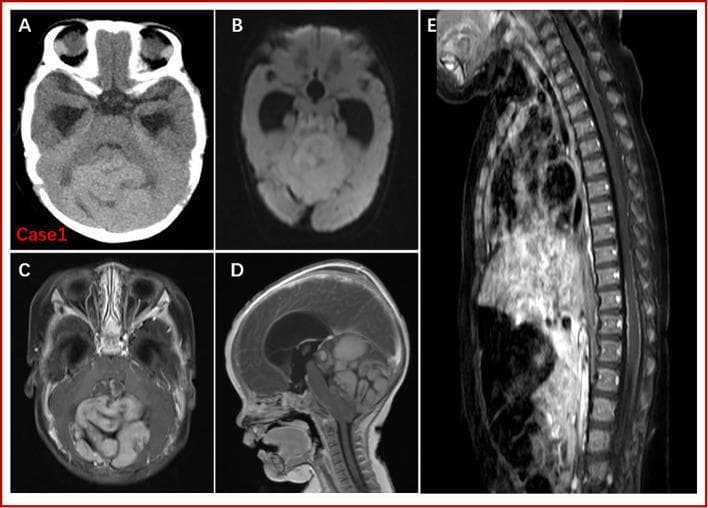This composite of diagnostic images displays a pediatric neuroimaging case involving a large posterior fossa tumor, consistent with medulloblastoma with extensive nodularity (MBEN) in a patient with Gorlin-Goltz syndrome. (A) Axial non-contrast CT shows a slightly hyperdense mass in the posterior fossa with ill-defined borders. (B) Diffusion-weighted imaging (DWI) demonstrates high signal intensity, suggesting high cellularity and restricted diffusion. (C) Axial and (D) sagittal Gd-enhanced T1-weighted images reveal a large, heterogeneously enhancing mass with a characteristic multinodular appearance. Secondary effects include significant compression of the brainstem, narrowing of the fourth ventricle, and obstructive supratentorial hydrocephalus, indicated by dilated ventricles. (E) Sagittal Gd-enhanced MRI of the spinal cord shows thin, linear enhancement and small nodular signals along the spinal cord surface, concerning for leptomeningeal dissemination or drop metastases. The findings emphasize the importance of neuraxis screening in primary central nervous system tumors. This educational material is suitable for neurosurgical and radiological clinical training.