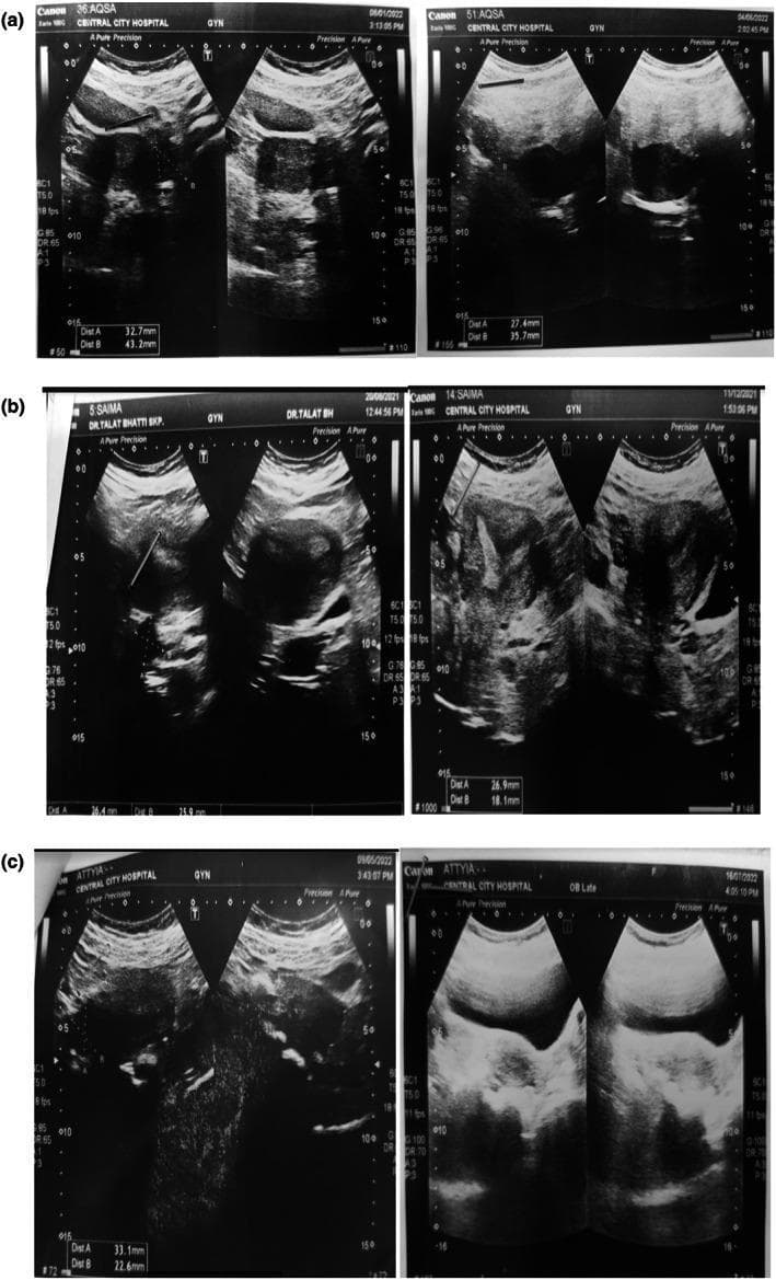 This composite of transvaginal pelvic ultrasound scans demonstrates the comparative morphology of ovaries in three patients (a, b, c) before and after a clinical intervention for polycystic ovary syndrome (PCOS). In the 'before' images (left columns), the ovaries exhibit classic polycystic ovarian morphology (PCOM): multiple small, hypoechoic, rounded cystic structures or follicles distributed throughout the ovarian stroma or arranged peripherally. Many of these ovaries appear bulky with heterogeneous internal echotexture. The 'after' images (right columns) show a notable reduction in the size and quantity of these cystic follicles. Quantitative measurements (Dist A and Dist B) across all panels indicate a decrease in overall ovarian dimensions post-treatment. The resulting ovarian parenchyma appears more uniform and homogeneous. These diagnostic images illustrate the transition from a multicystic state characteristic of PCOS to a more typical ovarian appearance, serving as a visual baseline for monitoring treatment efficacy in reproductive endocrinology and gynecology.
