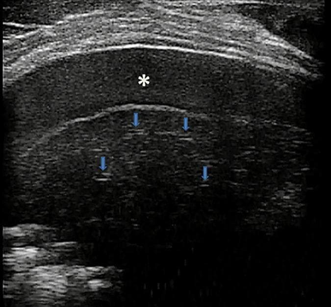 This grayscale lung ultrasound image (transverse intercostal scan) illustrates key diagnostic features of bacterial lobar pneumonia. A significant area of subpleural consolidation is visible, demonstrating 'hepatization' where the lung tissue exhibits a tissue-like, hypoechoic echogenicity similar to liver parenchyma. Within this consolidated region, several small, hypoechoic tubular structures are identified by blue arrows, representing fluid bronchograms (fluid-filled bronchi). Superior to the consolidated lung, a hypoechoic to anechoic space marked by an asterisk (*) indicates a fibrinous inflammatory reactive pleural effusion. The visceral and parietal pleurae are separated by this fluid collection, which contains fine internal echoes suggestive of fibrin or debris. This image is an educational example of point-of-care ultrasound (POCUS) findings in pediatric pulmonary infection, highlighting the loss of normal lung aeration and the development of secondary pleural complications.