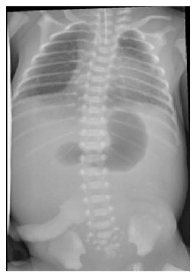 This diagnostic abdominal and chest X-ray of a neonate demonstrates the classic 'double bubble' sign, highly characteristic of duodenal atresia. The image shows two prominent, gas-distended radiolucent structures in the upper abdomen: a larger lucency on the left representing the dilated stomach and a smaller lucency to the right representing the dilated proximal duodenum. Crucially, there is a complete absence of distal bowel gas throughout the lower abdomen and pelvis, indicating a high-grade intestinal obstruction. The thoracic portion of the radiograph shows the ribcage and spine, with an orogastric tube visible, though its distal tip is not clearly identified within the stomach bubble. This imaging is a hallmark for neonatal surgical emergencies and is frequently associated with congenital conditions such as Down syndrome or VACTERL association, particularly when seen alongside tracheo-oesophageal fistula or anorectal malformations.