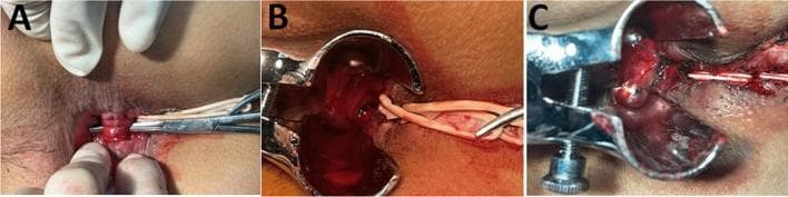 This composite of three clinical photographs (A, B, C) illustrates a surgical procedure for high trans-sphincteric or suprasphincteric anal fistulas, specifically the 'Decompression and Drainage Seton' (DADS) technique. Panel A shows the perianal surgical field where a seton has been rerouted through the intersphincteric plane and tied loosely around the external anal sphincter (EAS); a curved artery forceps is seen inserted through the internal opening to identify the intersphincteric tract. Panel B demonstrates the surgical exposure of the anal canal using a bivalve speculum, where the internal sphincter is being incised via electrocautery to open the fistula tract. Panel C displays the final stages of the procedure, showing the marsupialization of the operative wound. Interrupted absorbable sutures (polyglactin 3-0) are visible along the edges of the opened fistula tract, securing the mucosa to the underlying tissue from distal to proximal to facilitate continuous drainage and secondary intention healing. This visual series highlights key steps in sphincter-preserving proctological surgery for complex fistula-in-ano.