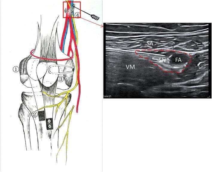 This composite educational image illustrates a '3-in-1' surgical procedure for recurrent patellar dislocation (RPD) alongside an ultrasound-guided adductor canal block (ACB). The left anatomical diagram depicts the surgical components: (1) lateral patellofemoral ligament release to loosen the lateral retinaculum; (2) distal realigning via lower-inner transfer of the tibial tuberosity, shown fixed with two screws; and (3) reconstruction of the medial patellofemoral ligament (MPFL) using a graft tendon. Step (4) demonstrates the needle placement for an adductor canal block relative to the femoral neurovascular bundle. The right panel is a transverse ultrasound scan of the medial mid-thigh, labeled for regional anesthesia. It identifies the sartorius (SA) muscle superficially and the vastus medialis (VM) muscle laterally. Within the adductor canal (outlined in red), the hypoechoic saphenous nerve (SN) and the pulsatile femoral artery (FA) are clearly visible. This figure serves as a clinical guide for orthopedic surgeons and anesthesiologists managing patellar instability through combined surgical correction and regional analgesia.