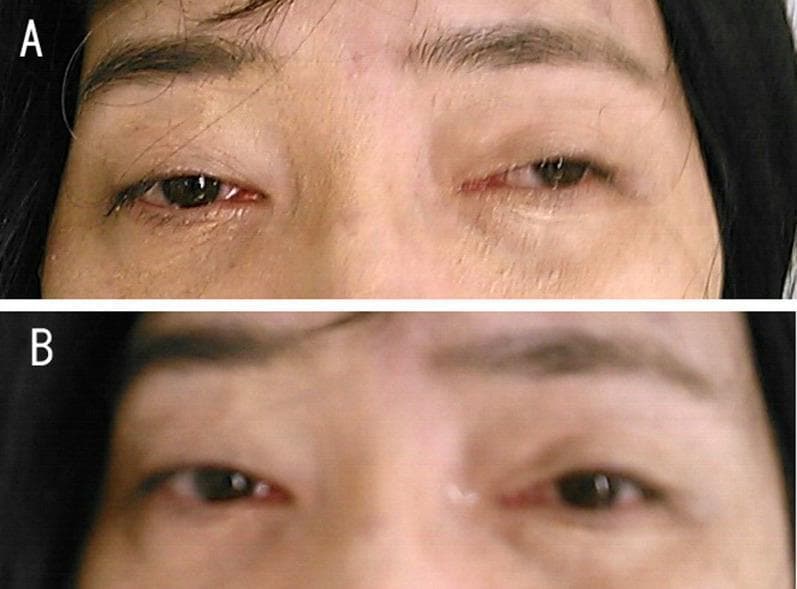 This clinical photograph is a side-by-side comparison illustrating a positive Tensilon (edrophonium) test in a patient with Myasthenia Gravis (MG). Panel A shows the patient's orbital region at baseline, demonstrating significant bilateral asymmetrical ptosis (drooping of the upper eyelids). The left eyelid is more severely affected, covering a substantial portion of the visual axis. Panel B shows the same patient after the administration of edrophonium, an acetylcholinesterase inhibitor. There is a marked improvement in the bilateral ptosis, characterized by an increased palpebral fissure width and elevation of the upper lid margins, exposing more of the iris and pupil. This visual change is a classic diagnostic indicator for disorders of the neuromuscular junction, specifically MG associated with anti-acetylcholine receptor (AchR) antibodies. The image serves as a clinical teaching tool for neurology and ophthalmology to demonstrate the transient reversal of fatiguable muscle weakness through pharmacological intervention.