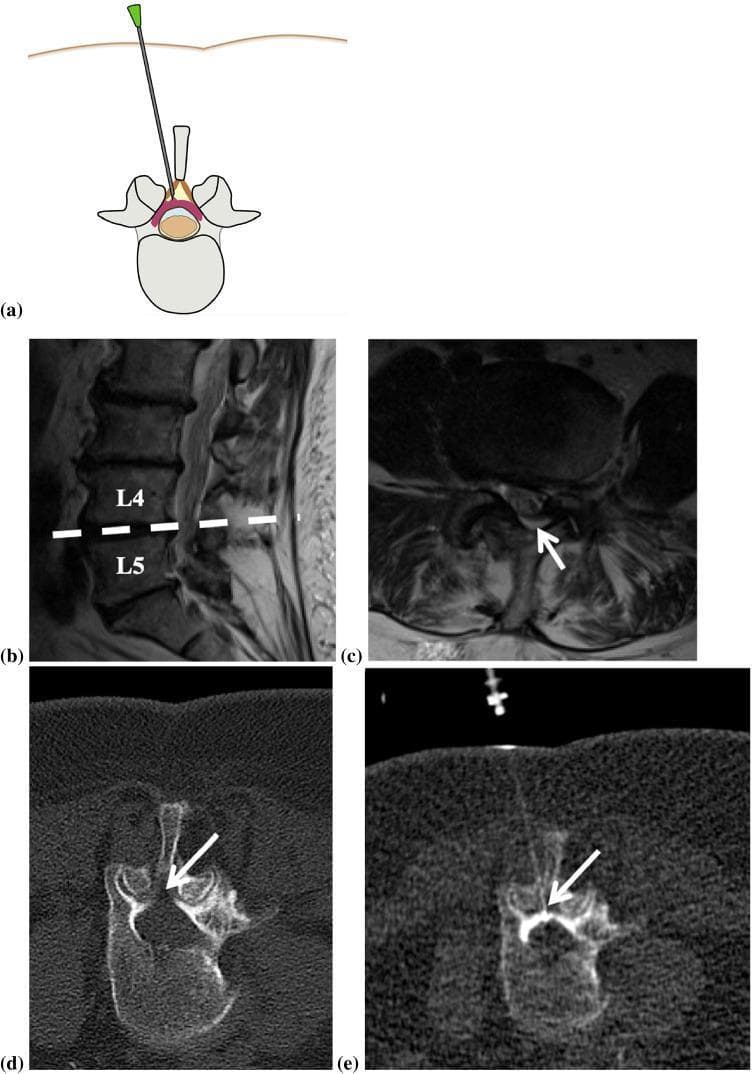 This composite educational graphic illustrates a CT-guided lumbar epidural steroid injection procedure. Panel (a) provides an anatomical diagram in the axial plane showing the spinal needle entering the posterior epidural space with tip placement in the dorsal epidural fat triangle. Panel (b) is a sagittal T2-weighted MRI of the lumbar spine of a 70-year-old female, highlighting multisegmental degenerative changes at L4 and L5. Panel (c) shows a corresponding axial T2-weighted MRI at the L4/L5 level, with an arrow indicating significant spinal canal stenosis. Panels (d) and (e) are axial helical planning and intra-procedural CT scans, respectively. Panel (d) identifies the target zone in the epidural fat (arrow). Panel (e) demonstrates the final needle tip position within the dorsal epidural space during the infiltration. The series illustrates the clinical pathway from diagnostic imaging of lumbar stenosis to the interventional management of chronic back pain using CT fluoroscopy navigation for precise needle localization.