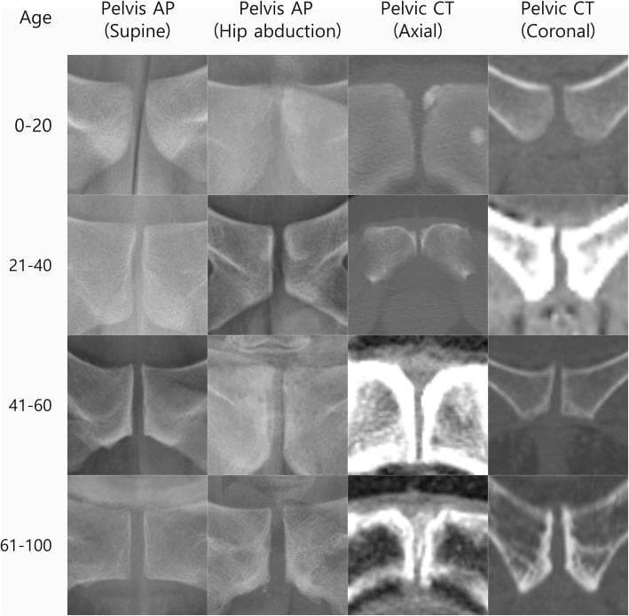 This diagnostic comparison chart illustrates the morphological changes of the pubic symphysis across four age groups (0-20, 21-40, 41-60, and 61-100 years) using four imaging modalities: Pelvis AP (supine), Pelvis AP (hip abduction), Pelvic CT (axial), and Pelvic CT (coronal). The 4x4 grid demonstrates a clear progression of joint space alterations and bony remodeling. In the younger cohorts (0-40 years), the symphysis shows smooth articular surfaces and relatively narrow, uniform joint spaces. With advancing age (41-100 years), there is a visible trend toward increased joint width, cortical thickening, and sclerosis. In the 61-100 year group, particularly in the CT axial and coronal views, significant degenerative features are evident, including irregular joint margins, subchondral sclerosis, and osteophyte formation. This visual sequence is designed for orthopedic and radiological education to assist in identifying normal age-related changes versus pathological degeneration of the pubic symphysis joint.