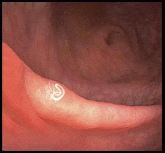 This diagnostic clinical photograph captures an endoscopic view of the colon during a colonoscopy, specifically at the terminal ileum and cecum. The image demonstrates a parasitic infection within the gastrointestinal tract. Visible on the healthy, pinkish-red mucosal surface are multiple thread-like worms, identified in clinical context as Hymenolepis nana. These parasites appear as bright white, slender, and translucent organisms exhibiting both linear and tightly coiled configurations. The underlying intestinal mucosa shows no overt signs of secondary pathology such as severe inflammation, ulceration, or mucosal bleeding. This image illustrates a case of helminthic infestation, which in this clinical setting relates to opportunistic reactivation in an immunocompromised patient. The visual is of high educational value for gastroenterology and infectious disease specialties, providing a clear demonstration of macroscopically visible intestinal parasites during direct visualization.