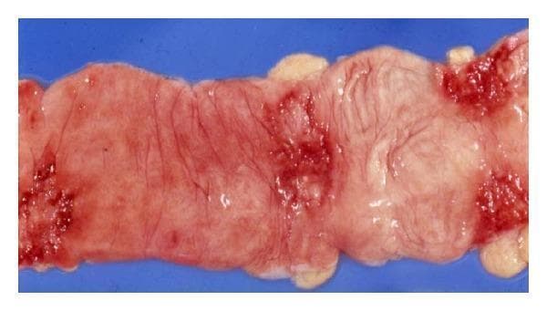 Gross pathology clinical photograph of a resected segment of the human ileum demonstrating intestinal tuberculosis. The specimen displays multiple transverse, circumferential ulcers that characteristically follow the orientation of the Peyer's patches. The ulcers exhibit distinct reddish, hemorrhagic surfaces with irregular and indurated (thickened) borders. The surrounding mucosa appears edematous and inflamed, with evidence of architectural distortion and tissue friability. These visual findings are classic for Mycobacterial infection of the gastrointestinal tract, highlighting the pathogenesis of ulcerative lesions that can lead to stricture formation or intestinal obstruction. This image serves as an educational reference for infectious disease, gastroenterology, and surgical pathology, illustrating the localized inflammatory response and mucosal destruction in abdominal tuberculosis.