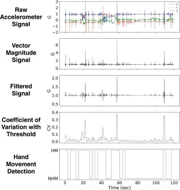 This infographic demonstrates a signal processing algorithm for detecting hand movement in clinical monitoring, particularly for Parkinson’s disease tremor and bradykinesia assessment. The image contains five stacked time-series graphs spanning 120 seconds. 1) Raw Accelerometer Signal: Shows triaxial (X, Y, Z) data from a wrist-worn sensor. 2) Vector Magnitude Signal: Represents the orientation-independent magnitude derived from the raw data. 3) Filtered Signal: Displays the data after a low-pass Butterworth filter is applied to remove high-frequency noise and tremor components. 4) Coefficient of Variation (CV) with Threshold: Illustrates a rolling CV calculation with an empirical threshold (red line at 0.01) to identify signal variability. 5) Hand Movement Detection: A binary classification output differentiating between ‘HM’ (Hand Movement) and ‘NHM’ (No Hand Movement) based on the CV exceeding the threshold. This sequence illustrates the data science pipeline used to extract objective motor symptoms from wearable sensors for diagnostic and treatment-monitoring purposes.