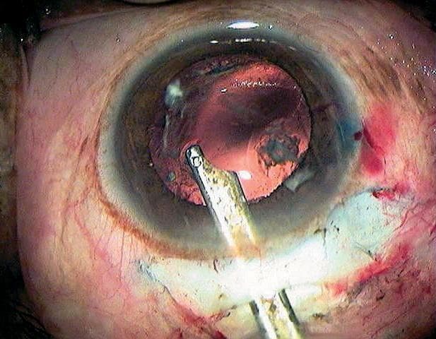 This clinical photograph captures a surgical step during Small Incision Cataract Surgery (SICS). The image shows an operative field of the human eye under surgical illumination. A metallic Simcoe cannula is inserted through a corneal-scleral tunnel incision into the anterior chamber. The cannula tip is positioned near the capsular opening, where it is being used to aspirate residual white lens cortex material. The posterior capsule is visible behind the iris, showing signs of a surgical opening. The surrounding conjunctiva and sclera exhibit expected surgical trauma, including minor subconjunctival hemorrhage and hyperemia from tissue manipulation. The cornea remains relatively transparent, providing a clear view of the intraocular structures and the irrigation-aspiration process. This visual demonstrates the essential technique of cortical cleanup to ensure a clear visual axis before intraocular lens (IOL) implantation in ophthalmological surgery.