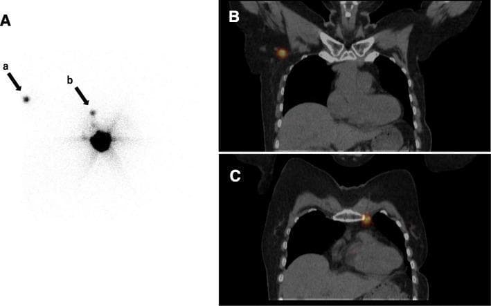 This three-panel composite image displays diagnostic nuclear medicine imaging demonstrating aberrant lymphatic drainage in a patient with ipsilateral breast tumor recurrence (IBTR). Panel A is a planar lymphoscintigraphy image showing a large central area of radiotracer uptake at the injection site. Two secondary foci of uptake are visible: arrow 'a' indicates drainage to the contralateral axilla, and arrow 'b' indicates drainage to the ipsilateral internal mammary chain (IMC). Panels B and C show coronal SPECT/CT fusion images providing anatomical localization for these findings. Panel B demonstrates a 'hot spot' (focal radiotracer uptake) in the right axillary region adjacent to the thoracic wall. Panel C illustrates a 'hot spot' localized to the left internal mammary chain, situated lateral to the sternum. These images illustrate the utility of SPECT/CT in identifying sentinel lymph nodes in non-axillary or contralateral basins, which is clinically significant for staging and surgical planning in recurrent breast cancer cases where normal lymphatic pathways may be surgically disrupted.