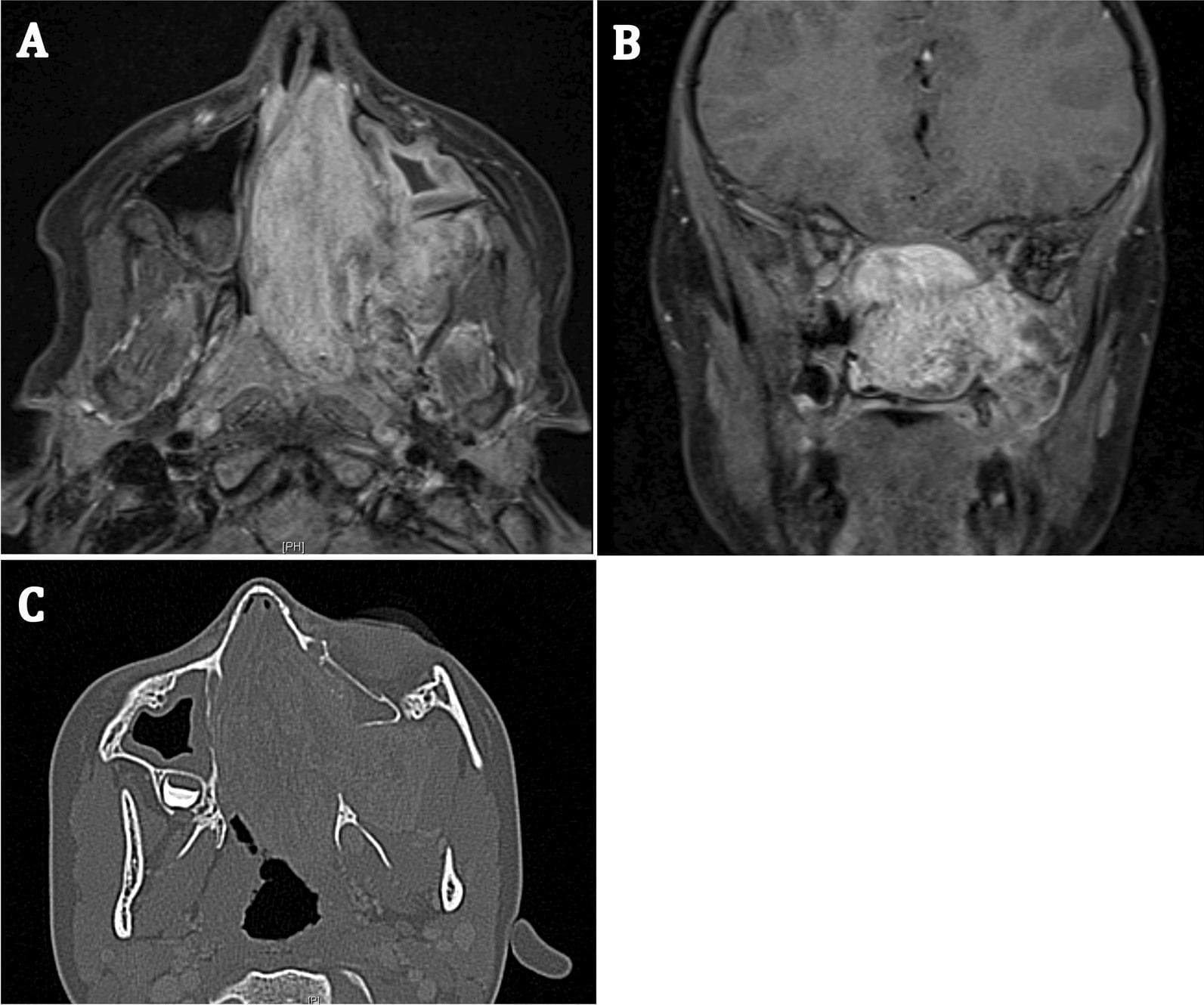 This composite diagnostic image displays a Juvenile Nasopharyngeal Angiofibroma (JNA) in a 7-year-old patient using three radiological views. Panels A (axial) and B (coronal) are MRI scans showing a large, heterogeneously enhancing mass that occupies the nasal cavity and extends into the left pterygopalatine fossa. The mass exhibits irregular boundaries and mixed signal intensity, characteristic of this hypervascular tumor. Panel C provides an axial CT scan (bone window), illustrating the tumor's impact on local anatomy, including bone remodeling, significant widening of the pterygopalatine fossa (Holman-Miller sign), and erosion of adjacent bony structures. The images demonstrate the typical local aggressiveness and spread patterns of JNA into the paranasal sinuses and skull base regions. These findings are critical for preoperative staging and surgical planning, particularly for endoscopic trans-pterygoid approaches.