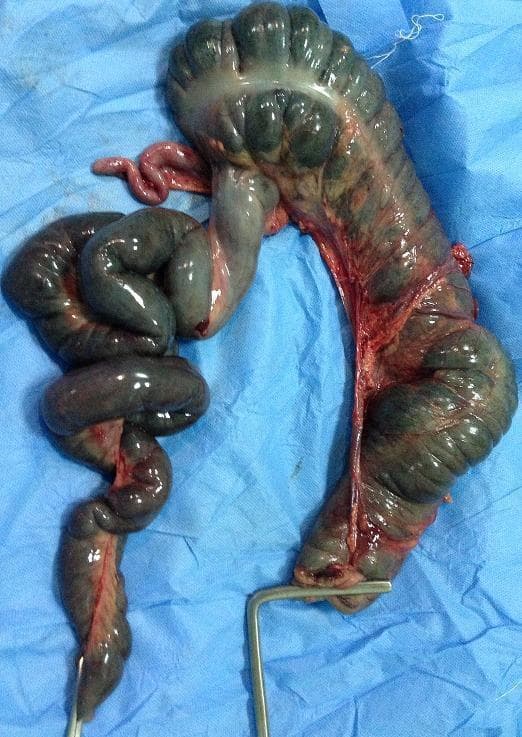 This clinical photograph shows a resected gross specimen of the small and large intestine, displayed on a blue sterile surgical drape. The specimen demonstrates severe ischemic changes and necrosis resulting from midgut volvulus associated with malrotation (incompletely rotated mesentery). The intestinal loops are significantly dilated and exhibit a dark, dusky, blue-black discoloration, indicating transmural infarction and gangrene. The bowel wall appears edematous with a shiny, serosal surface. Portions of the mesentery are visible, showing intense vascular congestion and hemorrhagic infiltration. A metallic surgical instrument is used to orient the specimen. This image illustrates the surgical outcome of an acute intestinal obstruction and malrotation, emphasizing the severity of vascular compromise that necessitates subtotal colectomy and extensive bowel resection.