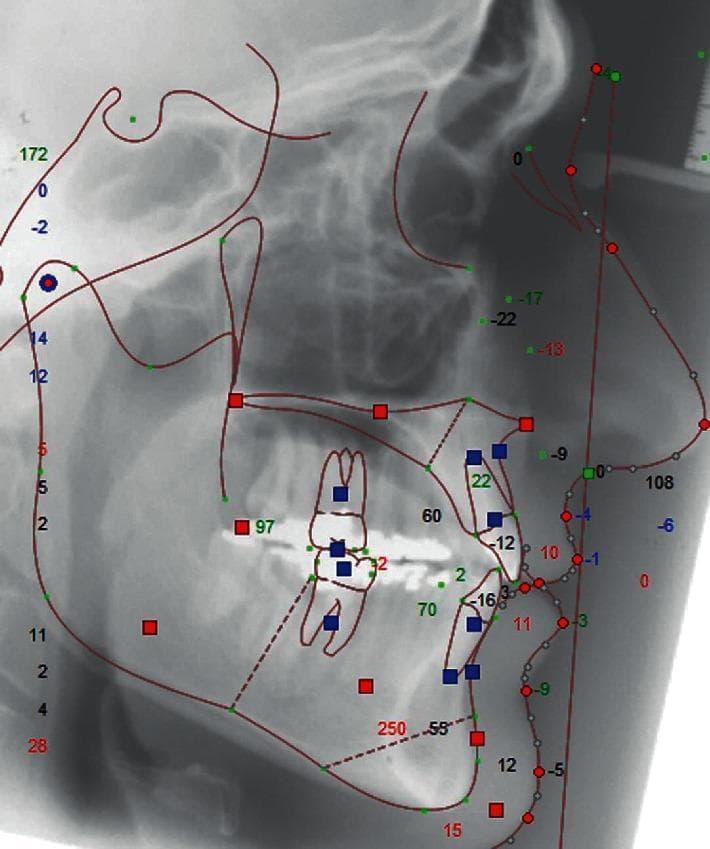 This diagnostic image shows a lateral cephalometric radiograph with a superimposed digital cephalometric tracing, commonly used in orthodontics and orthognathic surgery planning. The tracing utilizes red lines to delineate key anatomical contours, including the sella turcica, nasal bones, maxilla, mandible, and the soft tissue facial profile. Multi-colored markers (green dots, red squares, and blue squares) identify specific cephalometric landmarks such as Point A, Point B, Pogonion, Menton, and various dental positions. Numerical values in red, green, and blue text are dispersed throughout the tracing, representing angular and linear measurements essential for analyzing skeletal and dental relationships. Particular emphasis is placed on the maxillomandibular relationship and the dental occlusion, which are critical for assessing Class III malocclusion and orthodontic camouflage outcomes. The image illustrates the integration of radiographic imaging with quantitative analysis to evaluate facial profile aesthetics and treatment efficacy.