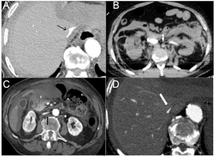 This set of four Contrast-Enhanced Computed Tomography (CECT) axial images illustrates the characteristic radiologic findings of hypovolemic shock across different subtypes. Image A demonstrates a 'slit-like' inferior vena cava (IVC) (arrow) at the level of the liver, signifying severe intravascular volume depletion. Image B shows a small-caliber, hypoenhanced aorta (arrow), a key feature of traumatic hemorrhagic shock following significant blood loss. Image C reveals a flat IVC (black arrow) associated with ascites, common in non-traumatic hypovolemic shock where circulating plasma volume is critically reduced. Image D exhibits a flat IVC with the 'halo sign' (white arrow), appearing as a low-attenuation ring around the vessel, often seen in traumatic hypovolemic shock such as severe burn injuries. Together, these diagnostic images highlight the vascular collapse of the IVC and aorta as primary indicators of inadequate perfusion and reduced cardiac preload, essential for identifying shock stages in emergency radiology.