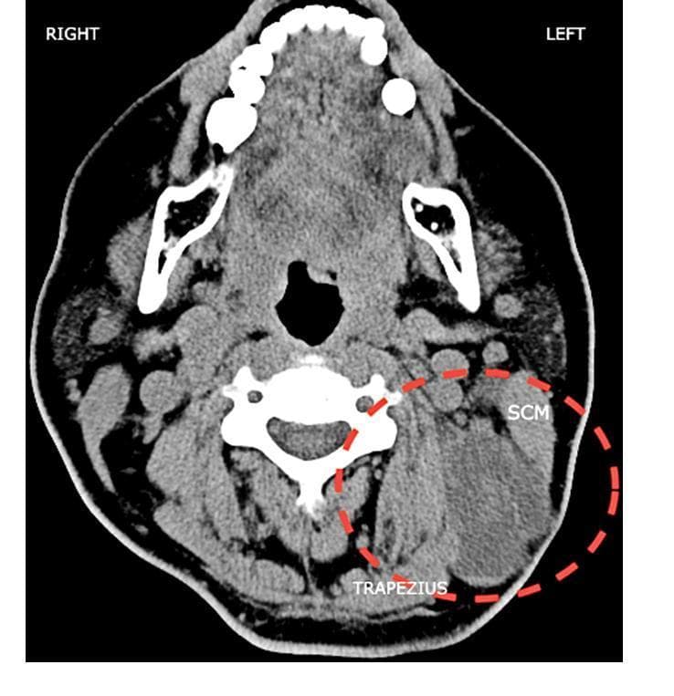 This diagnostic image is an axial computed tomography (CT) scan of the neck at the level of the upper cervical spine, illustrating significant cervical lymphadenopathy. The primary finding is a large, heterogeneous, soft-tissue mass in the left lateral neck, delineated by a red dashed circle. The mass measures approximately 6.8 x 5.1 cm and is situated within levels II, III, and V of the cervical lymph node stations. It is seen abutting the deep surface of the sternocleidomastoid (SCM) muscle and extending posteriorly toward the trapezius muscle, with poorly defined margins that suggest extracapsular extension or infiltration. In contrast, the right side of the neck demonstrates normal anatomical symmetry with smaller, discrete lymph nodes of uniform density. Clinical context indicates this mass represents metastatic squamous cell carcinoma originating from a scalp ulcer. The image highlights the use of cross-sectional imaging in staging head and neck malignancies and evaluating the relationship between metastatic nodes and vital musculoskeletal structures.