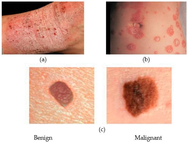 This composite clinical photograph illustrates common dermatological conditions for comparative medical education. Panel (a) shows atopic dermatitis (eczema) presenting as a diffuse, erythematous, and pruritic-appearing rash with visible excoriation, lichenification, and scaling on an extremity. Panel (b) depicts psoriasis, characterized by well-demarcated, erythematous papules and plaques with a silvery-white micaceous scale, distributed in a nummular (coin-shaped) pattern. Panel (c) provides a side-by-side comparison of melanocytic lesions: the 'Benign' lesion (likely a melanocytic nevus) exhibits a symmetrical oval shape, regular borders, and uniform reddish-brown pigmentation; the 'Malignant' lesion (malignant melanoma) demonstrates classic ABCDE warning signs, including asymmetry, irregular or notched borders, and variegated, dark brown-to-black pigmentation. The image serves as a visual guide for distinguishing between inflammatory skin diseases and neoplastic lesions, emphasizing morphology, border definition, and pigmentation patterns in clinical dermatology.