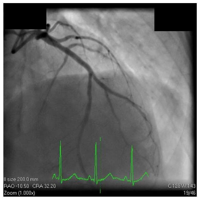 This diagnostic image is a coronary angiogram of the left coronary artery system, captured in a cranial radiographic projection (RAO -10.50, CRA 32.20). The image demonstrates the anatomy post-percutaneous coronary intervention (PCI). The Left Anterior Descending (LAD) artery is the dominant vessel coursing down the interventricular groove, showing a patent lumen and improved blood flow following angioplasty and stent implantation. A significant diagonal branch is visible bifurcating from the LAD, also showing adequate distal perfusion. The contrast-enhanced vasculature appears as dark radiopaque structures against a lighter fluoroscopic background, outlining the arterial tree's branching morphology. Technical parameters including image size, zoom, and window/contrast levels are displayed in the margins. A synchronized green electrocardiogram (ECG) tracing is superimposed at the bottom, indicating a regular sinus rhythm during the procedure. This image serves as a clinical record of successful revascularization in a patient with coronary artery disease.