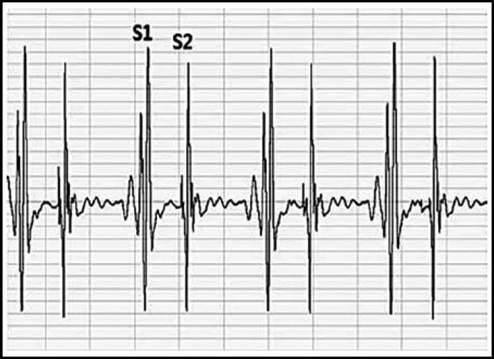 This diagnostic image displays a phonocardiogram tracing showing the amplitude waves of heart sounds recorded via an esophageal stethoscope. The waveform presents a rhythmic, repeating sequence of high-amplitude vertical spikes against a grid background. Key cardiac cycle components are labeled: 'S1' indicates the first heart sound (associated with mitral and tricuspid valve closure during ventricular systole) and 'S2' indicates the second heart sound (associated with aortic and pulmonic valve closure during ventricular diastole). Visually, S1 exhibits a slightly higher peak amplitude and sharper complex compared to S2. The interval between S1 and S2 represents the systolic phase, while the longer interval following S2 before the next S1 represents the diastolic phase. The baseline activity between these primary peaks is relatively stable with minimal noise, demonstrating the clinical utility of filtered esophageal recording for monitoring cardiac acoustic signals and assessing correlations between heart sound intensity and hemodynamic parameters like systolic blood pressure.