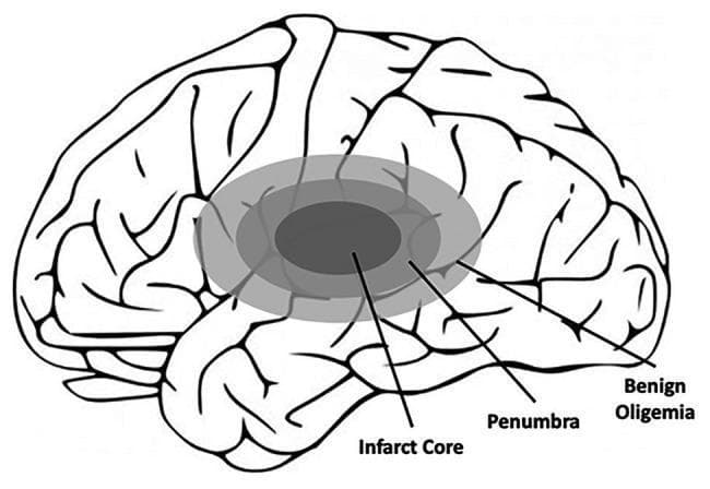 This medical schematic illustrates the pathophysiology of an ischemic stroke within the human brain, specifically identifying the concentric zones of tissue damage. The diagram uses a lateral view of the cerebral hemisphere, with simplified black outlines representing cortical gyri and sulci. Overlaid on the temporal and parietal regions is a three-tiered shaded model representing the ischemic gradient. 1. The 'Infarct Core' is the innermost, dark-shaded oval, representing irreversibly damaged necrotic tissue where blood flow is most severely restricted. 2. Surrounding the core is the 'Penumbra,' shown in a medium gray shade, representing functionally impaired but potentially salvageable tissue if reperfusion is achieved timely. 3. The outermost layer is labeled 'Benign Oligemia,' depicted in a light gray shade, representing tissue with reduced blood flow that is not yet functionally compromised and is expected to recover spontaneously. This illustration serves as a clinical education tool for understanding stroke evolution, the 'time is brain' concept, and the therapeutic target for neuroprotective and thrombolytic interventions.