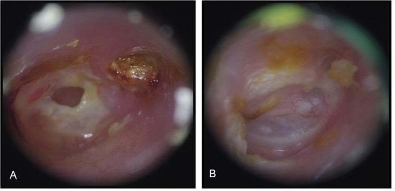 This side-by-side clinical comparison presents two otoscopic views of the external auditory canal and tympanic membrane, illustrating the management of acquired middle ear cholesteatoma. (A) Preoperative otoscope image: This diagnostic view reveals significant pathology, including a deep attic retraction pocket containing a brownish, desiccated mass of keratin debris (cholesteatoma). A prominent central perforation of the tympanic membrane is visible, with surrounding mucosal inflammation and irregular edges. (B) Postoperative otoscope image: Taken 12 months after functional tympanomastoidectomy, this image demonstrates a successful surgical outcome. The external auditory canal is healed, dry, and patent. The reconstructed tympanic membrane is fully intact, exhibiting a healthy translucent appearance with visible fine vascularization and no signs of recurrent retraction or keratin accumulation. Minor amounts of physiological cerumen (earwax) are noted. This comparison illustrates the transition from a chronically diseased state with structural defects to a restored, stable anatomical configuration following surgical intervention for cholesteatoma.