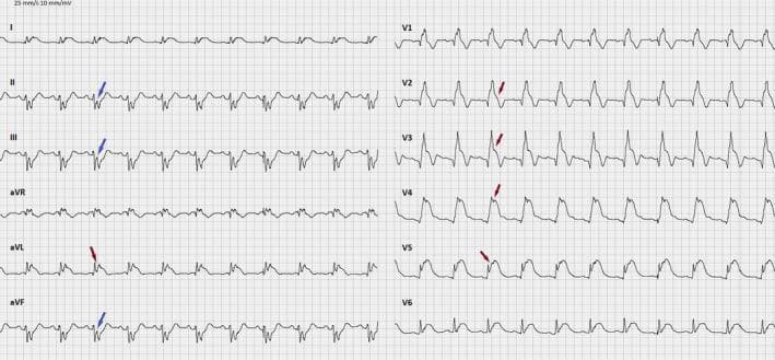 This diagnostic image is a 12-lead electrocardiogram (ECG) demonstrating an acute ST-elevation myocardial infarction (STEMI) involving the anterior and lateral walls. The tracing shows sinus rhythm with significant concave-downwards ST-segment elevation (indicated by red arrows) most prominent in leads V2 through V5, and aVL, consistent with an acute occlusion of the left anterior descending (LAD) artery. Notable reciprocal ST-segment depression (indicated by blue arrows) is observed in the inferior leads (II, III, and aVF). The QRS morphology in lead V1 shows a secondary R wave (R') and widened QRS complex, suggestive of an associated right bundle branch block (RBBB). T-waves are hyperacute and upright in the leads with ST elevation, while T-wave inversion is seen in the inferior leads accompanying the reciprocal ST depression. This ECG provides a classic clinical demonstration of extensive anterior wall injury and the importance of recognizing reciprocal changes in identifying focal ischemia.