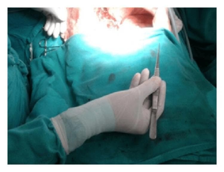 A clinical photograph depicting the correct ergonomic handling of DeBakey forceps within a sterile surgical field. The image shows a surgeon's hand, encased in a sterile white surgical glove, utilizing a pencil-style grip to hold the metallic forceps. The thumb and index finger are positioned on the textured handle area to provide fine motor control, maintaining a neutral wrist posture to minimize surgeon fatigue and enhance precision. The surgical environment is defined by green sterile drapes covering the patient, with exposed, out-of-focus reddish anatomical tissue visible in the background indicating the active operative site. The DeBakey forceps are characterized by their long, slender profile, specifically designed for atraumatic handling of delicate vascular or soft tissues. This visual serves as an educational tool for medical students and surgical residents to understand proper instrument ergonomics and the maintenance of a sterile field during invasive procedures.