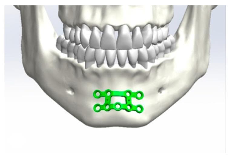 This anatomical diagram and simulation frame illustrates the application of internal fixation hardware in maxillofacial surgery. The image depicts an anterior view of a human skull focuses on the mandible (lower jaw) and dentition. A bright green osteosynthesis miniplate system is shown positioned over the mandibular symphysis. The hardware consists of a dual-plate configuration connected by vertical bars, forming a stable rectangular frame with multiple circular screw holes for rigid fixation. The plate is situated inferior to the roots of the mandibular incisors and cuspids, maintaining a safe distance from the dental apices to prevent trauma during screw insertion. This visualization demonstrates a common surgical approach for the management of mandibular midline or parasymphyseal fractures, highlighting the anatomical relationship between the mental protuberance, alveolar process, and the fixation device. The target educational focus is the biomechanical stabilization of the mandible and the anatomical landmarks essential for plate positioning in oral and maxillofacial trauma surgery.
