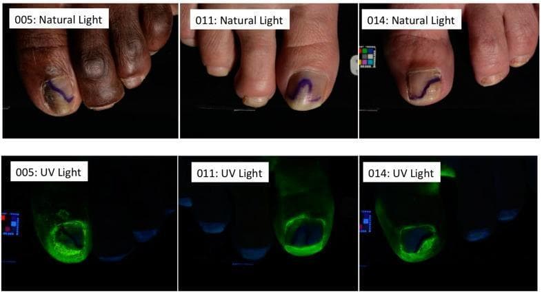 Clinical photographs depicting three subjects (005, 011, and 014) with onychomycosis, shown in a comparative side-by-side format under natural and UV light. The top row (Natural Light) displays hallmark signs of fungal infection: subungual hyperkeratosis, nail plate thickening, and yellow-brown chromonychia. Blue ink markings on the nail plates delineate the proximal boundary of the treatment area. The bottom row (UV Light) demonstrates the distribution of a fluorescently-labeled efinaconazole vehicle solution. The intense green fluorescence is concentrated at the hyponychium and subungual space, illustrating the delivery of the topical antifungal to the nail bed and matrix. Subject 005 exhibits the highest degree of disease severity with 55% nail involvement, while subjects 011 and 014 show 35% and 40% involvement, respectively. This comparison highlights the penetration capabilities of specialized vehicle formulations in penetrating the keratinized nail unit to reach the site of infection.