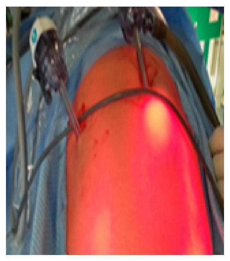 This clinical photograph shows an intraoperative view of a pediatric laparoscopic setup for a right congenital inguinal hernia repair. The patient's abdomen is prepped, draped in blue surgical cloth, and appears distended, indicating the presence of pneumoperitoneum. The surgical technique utilizes a two-port approach. A primary 5 mm umbilical port, featuring a white-capped ENDOPATH XCEL trocar, is seen on the left side of the frame, housing the laparoscope for visualization. A second 5 mm working port is inserted in the upper right quadrant of the abdomen. Both trocars are associated with connected fiber optic or insufflation tubing. The skin around the puncture sites shows minor erythema typical of acute surgical access. This image illustrates the minimally invasive port placement strategy used to evaluate internal rings and facilitate hernial sac neck closure in pediatric surgery.