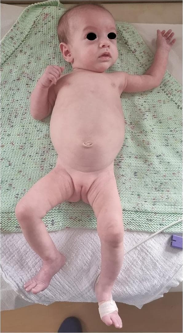 This clinical photograph displays a 5-month-old infant with systemic features indicative of a congenital infectious or metabolic syndrome, specifically congenital syphilis in this clinical context. Facial dysmorphism is prominent, including frontal bossing (prominent forehead), a depressed nasal bridge (saddle nose deformity) with a rounded nasal tip, a thin upper lip, and a small chin (micrognathia). The infant exhibits signs of significant nutritional compromise and malabsorption, characterized by pale skin, sparse hair on the scalp, and sparse eyebrows. The abdomen is markedly globose and distended, suggesting hepatosplenomegaly or ascites. The limbs appear dystrophic with evidence of muscle wasting and diminished subcutaneous fat. A medical bandage is visible on the left foot, likely for intravenous access or monitoring. This image serves as an educational reference for recognizing the systemic manifestations and physical stigmata of neonatal infectious diseases and associated growth failure.