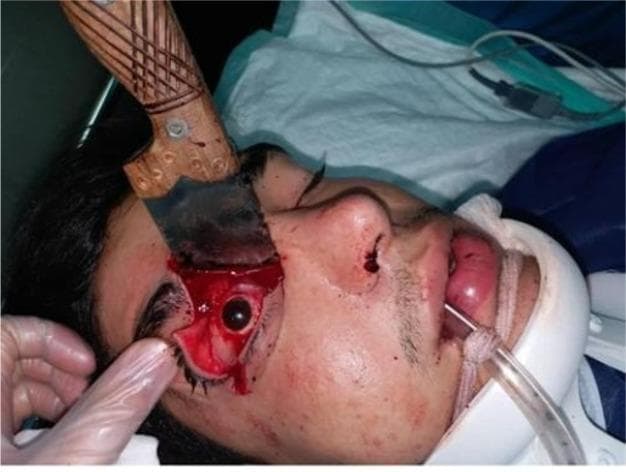 This clinical photograph depicts a severe penetrating orbital trauma (POT) in an adult male. A large knife is shown impaled in the right orbit, with the blade entering through the superior-medial aspect of the orbital cavity. The knife features a carved wooden handle and a wide metallic blade. Visible secondary injuries include a significant irregular laceration of the right upper eyelid and surrounding periorbital soft tissues, with active hemorrhage and exposed deep tissue. While the globe appears grossly intact in this view, the injury carries a high risk of optic nerve transection and orbital wall fractures. The patient is shown in a clinical setting, stabilized with a cervical collar and an endotracheal tube in situ, indicating an emergent trauma management scenario. This image illustrates the complexity of maxillofacial and ophthalmic trauma, emphasizing the need for multidisciplinary surgical intervention and the risk of permanent vision loss due to retrobulbar injury.