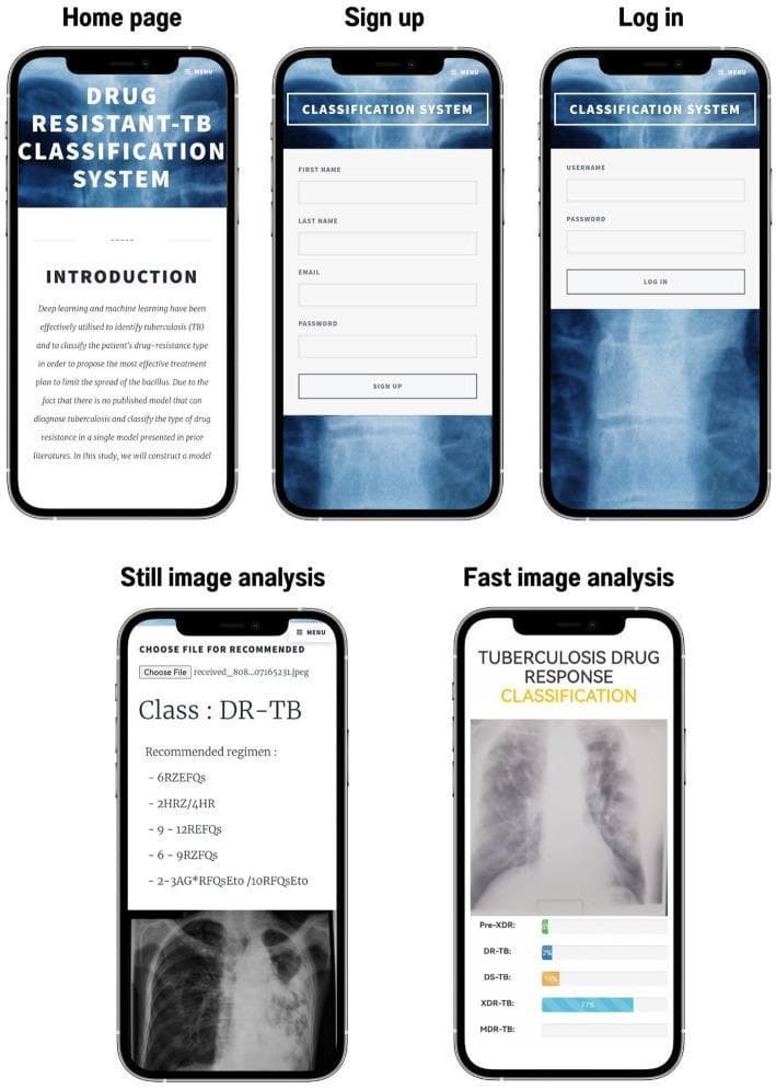 This infographic presents the mobile user interface (UI) of the TB-DRD-CXR application, an artificial intelligence tool designed for diagnosing drug-resistant tuberculosis (TB) using chest X-rays (CXR). The UI is displayed across five screens. The top row includes the 'Home page' with introductory text, followed by 'Sign up' and 'Log in' registration modules. The bottom row demonstrates the diagnostic functionalities: 'Still image analysis' and 'Fast image analysis'. The 'Still image analysis' screen allows for local file uploads, displaying the identified classification (e.g., DR-TB) and suggesting associated clinical treatment regimens. The 'Fast image analysis' screen features a live-camera interface that performs real-time classification. It provides a probability distribution for five distinct categories: drug-susceptible TB (DS-TB), drug-resistant TB (DR-TB), multidrug-resistant TB (MDR-TB), extensively drug-resistant TB (XDR-TB), and pre-extensively drug-resistant TB (Pre-XDR). These probabilities are visually represented using color-coded progress bars to assist medical professionals in rapid triage and diagnosis.