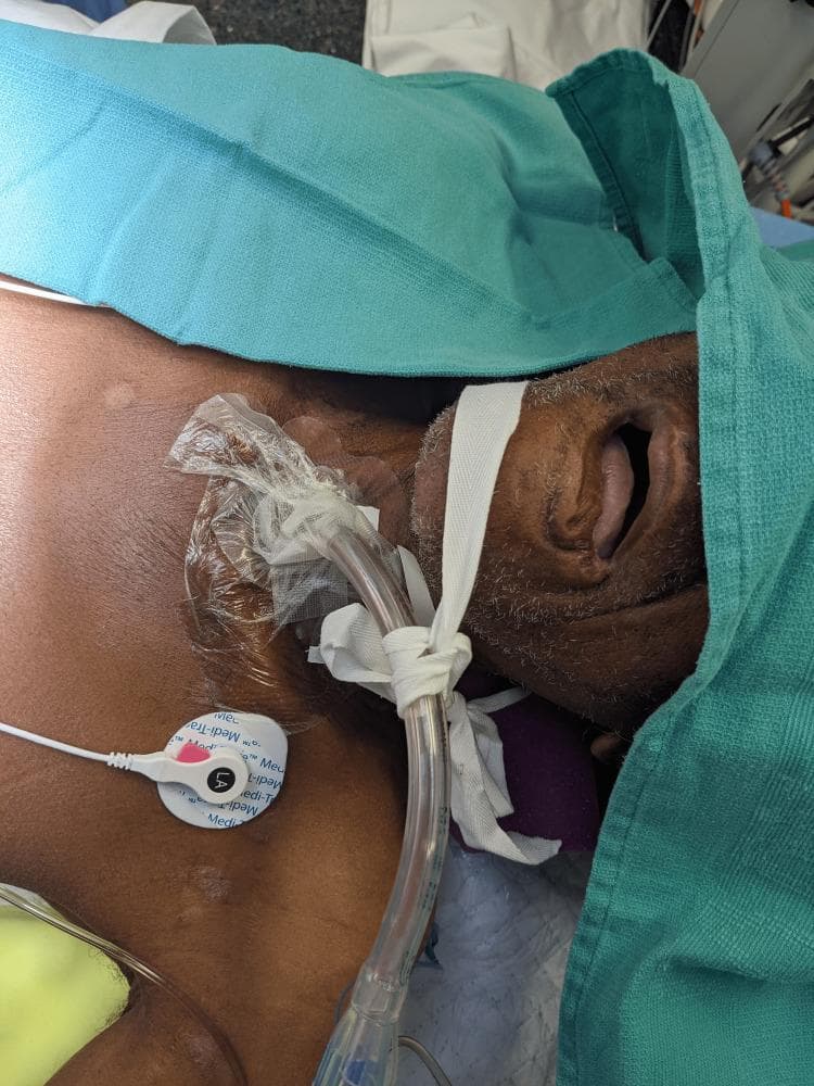 A clinical procedural photograph demonstrating the intraoperative management of a patient with a tracheostomy requiring lung isolation. The image shows a clear, flexible double-lumen endobronchial tube (DLT) inserted directly through an established tracheostomy stoma rather than the oral route. The DLT is secured at the stoma site using traditional white cloth tracheostomy ties knotted around the tube's flange and fastened around the patient's neck. A transparent occlusive dressing is applied over the peristomal skin to maintain sterility. The patient is in a supine position with the head supported by a purple positioning foam and the neck slightly extended. Green surgical drapes partially cover the head and upper torso. Visible monitoring equipment includes an ECG electrode adhered to the left upper chest with an attached white lead wire. White adhesive tape is applied across the maxilla and nose, and the mouth remains open. This image illustrates a specialized anesthetic technique for thoracic surgery in patients with pre-existing tracheostomies, highlighting the stabilization and positioning of airway devices.