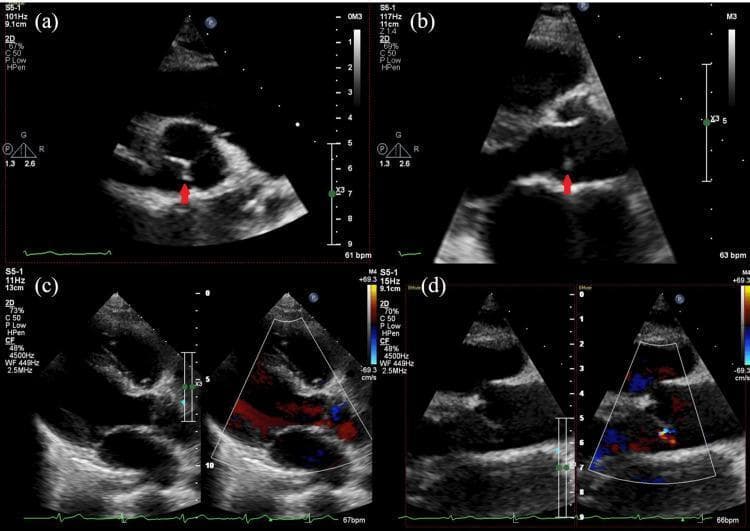 Transthoracic echocardiography (TTE) panel illustrating diagnostic findings of infective endocarditis. (a, b) Parasternal long-axis views in 2D mode showing a distinct, irregular echogenic mass (vegetation) attached to the aortic valve leaflet, indicated by red arrows. The vegetation displays independent motion and different acoustic properties compared to the valve tissue. (c, d) Parasternal long-axis views utilizing color flow Doppler to assess valvular function. These images demonstrate a mosaic-colored retrograde jet originating from the aortic valve and extending into the left ventricular outflow tract during diastole, diagnostic of mild aortic regurgitation. This educational visual facilitates the identification of major modified Duke criteria through imaging evidence of valvular vegetations and secondary valvular incompetence (regurgitation) in the clinical context of suspected cardiac infection.