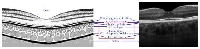 A comparison graphic of human ocular anatomy featuring an anatomical diagram alongside a high-resolution Spectral Domain Optical Coherence Tomography (SD-OCT) cross-section of the fovea and posterior segment. The image serves as an educational tool for ophthalmology, specifically identifying the microstructural layers of the retina and choroid. Starting from the inner retina and moving outward toward the sclera, the labeled structures include the foveal pit, retinal pigment epithelium (RPE), Bruch's membrane, and the subsequent choroidal layers: choriocapillaris, Sattler layer (small-to-medium vessels), Haller layer (large vessels), virtual suprachoroidal space, and Lamina fusca. The OCT image illustrates these as hyperreflective and hyporeflective bands, with the RPE appearing as a prominent bright band. This visual highlights the clinical methodology for measuring choroidal thickness, defined as the distance between the RPE-choroid interface and the sclerochoroidal interface. The image is designed for advanced medical education in diagnostic imaging and retinal pathology.