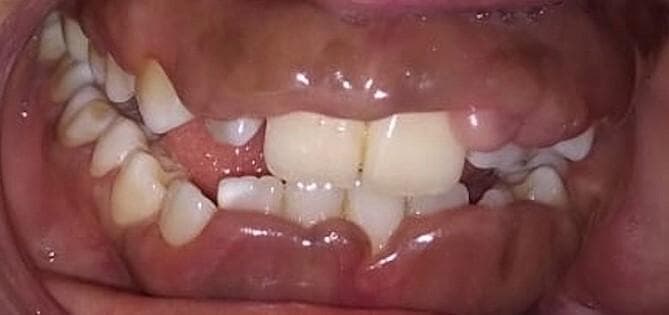 This clinical intraoral photograph demonstrates severe, generalized gingival enlargement, consistent with medication-induced gingival overgrowth (specifically phenytoin-induced). The gingiva exhibits significant hypertrophy and puffiness, primarily localized to the maxillary and mandibular anterior regions. The tissue is characterized by a distinctive bluish-red discoloration and a smooth, shiny surface texture indicating underlying edema. The hyperplastic gingiva significantly obscures the dental crowns, covering approximately two-thirds of the tooth surfaces. This presentation illustrates the classic clinical manifestation of drug-induced gingival hyperplasia, which often results in altered aesthetics, increased risk of periodontal disease due to difficult oral hygiene, and tissue friability during mastication. This image serves as a high-quality educational resource for dental and medical professionals studying oral pathology and the systemic side effects of anticonvulsant therapy.