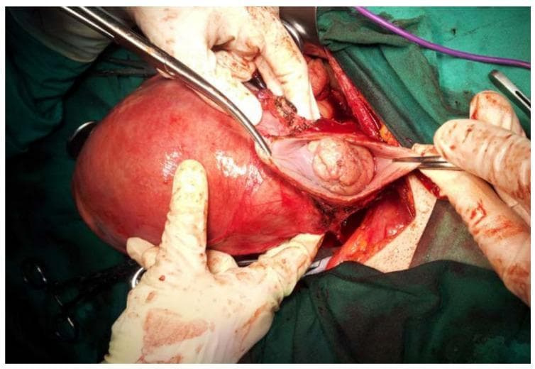 This clinical photograph captures an intraoperative view of an abdominal radical trachelectomy performed on a pregnant patient at 17 weeks of gestation for Stage IB2 cervical cancer. The primary anatomical focus is a significantly enlarged, gravid uterus, which displays a reddish-pink, smooth, glistening serosal surface and takes up the majority of the surgical field. To the right of the uterine corpus, surgical instruments and gloved hands retract tissues to expose the cervical region and paracervical structures. Visible within the dissected operative site is a prominent, pinkish-tan, lobulated mass consistent with the cervical tumor specimen. The image demonstrates the complex surgical anatomy involved in fertility-sparing oncological procedures during pregnancy, highlighting the relationship between the gravid uterus and the neoplastic cervical tissue being excised. The field includes surgical drapes, forceps, and evidence of tissue dissection and hemostasis typical of radical pelvic surgery in a gynecologic oncology context.