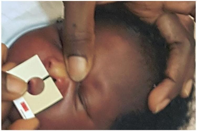 A clinical photograph depicting the assessment of neonatal jaundice in a dark-skinned infant using a Bilistrip™ device. The newborn's face is shown with visible yellowish icterus on the bridge of the nose and the periocular skin. An adult's hand holds the Bilistrip™, a 3.5 x 3.0 cm rectangular handheld tool, against the infant's mid-face. The device features a 1.3 cm central circular aperture used to isolate the skin for visual comparison against two calibrated shades of yellow on the strip. This visual screening method, modeled after the Ingram Icterometer, is used for point-of-care detection of hyperbilirubinemia in newborns. The educational focus is on clinical jaundice screening techniques and the visual manifestations of icterus in neonates with higher skin melanin content. The image demonstrates the application of a non-invasive diagnostic aid in a clinical or home-based triage setting for determining the need for serum bilirubin testing or phototherapy.