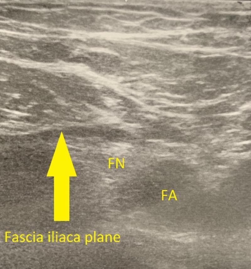 This diagnostic image is a gray-scale musculoskeletal ultrasound showing the regional anatomy of the inguinal area, specifically oriented for a fascia iliaca block (FIB). The visual demonstrates the fascia iliaca plane, marked by a prominent yellow arrow, which appears as a distinct hypoechoic linear interface separating the superficial muscle layers from deeper structures. Labeled in yellow text are the femoral nerve (FN) and femoral artery (FA), providing crucial landmarks for regional anesthesia. The femoral nerve is seen as a cluster of hyperechoic dots superior-medial to the pulsatile, anechoic femoral artery. The surrounding iliacus muscle exhibits a heterogeneous texture with characteristic hyperechoic septa. This image serves as a clinical guide for identifying the target injection site for a fascia iliaca compartment block, a procedure used for opioid-sparing analgesia in hip arthroplasty and femoral fractures. The visualization highlights the necessary precision for needle placement to ensure effective anesthetic spread across the femoral, lateral femoral cutaneous, and obturator nerves.