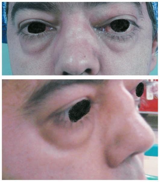 This clinical photograph consists of two panels (anterior and lateral views) showing the facial manifestations of Granulomatosis with Polyangiitis (formerly Wegener's Granulomatosis). In the upper anterior view, there is significant bilateral proptosis (exophthalmos), which is asymmetric and more pronounced in the left orbit. Accompanying this is marked bilateral periorbital and eyelid edema, along with conjunctival injection. Centrally, the nose exhibits a classic saddle nose deformity, characterized by a visible collapse and depression of the nasal bridge resulting from destruction of the underlying cartilaginous nasal septum. The lower lateral view confirms the profile of the saddle nose deformity, highlighting the depth of the bridge depression, and further illustrates the protrusion of the globe and the associated lower eyelid edema. These findings are clinically significant as classic markers of systemic granulomatous vasculitis involving the upper respiratory tract and orbits.