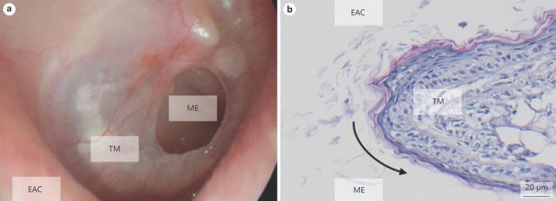 Educational visual regarding tympanic membrane perforation (TMP) and epithelialization, featuring clinical imaging and histology. Panel (a) is an otoscopic/microscopic clinical photograph showing a clear, oval-shaped perforation in the tympanic membrane (TM). The middle ear (ME) is visible through the defect. The margins of the perforation are distinct and rounded, demonstrating characteristic epithelialization. Panel (b) presents a high-magnification histology section stained with Hematoxylin and Eosin (H&E), showing the TM cross-section at the perforation edge. It illustrates the overgrowth of keratinizing squamous epithelium from the external auditory canal (EAC) side, curling around the defect margin toward the middle ear (ME) surface. A black arrow indicates the direction of epithelial migration, which inhibits spontaneous closure by creating a continuous skin layer over the wound edge. This composite serves as a diagnostic and pathological reference for chronic tympanic membrane defects and wound healing failure in otolaryngology.