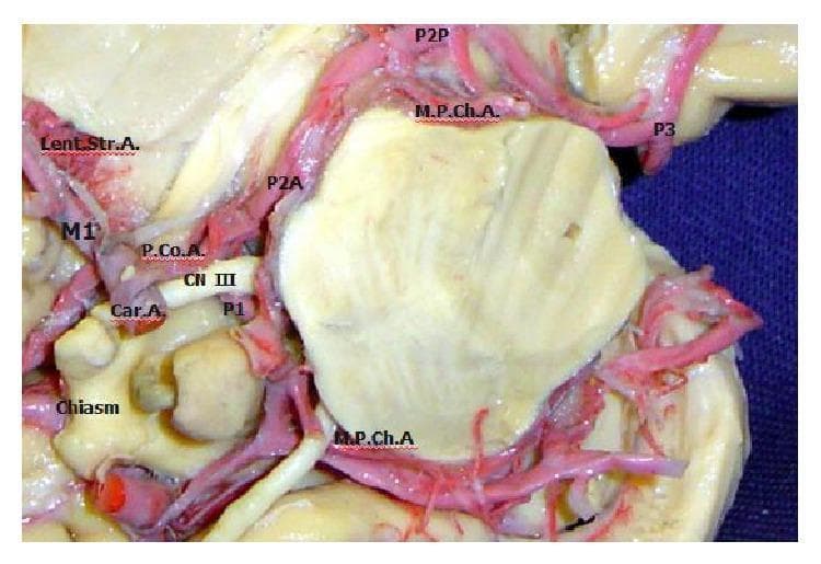 An anatomical diagram featuring a high-magnification photograph of a cadaveric brain dissection, illustrating the neurovascular relationships at the base of the brain. The image highlights the Circle of Willis and associated cranial nerves. Key vascular structures labeled include the internal carotid artery (Car. A.), which branches into the first segment of the middle cerebral artery (M1) and the posterior communicating artery (P.Co.A.). The posterior cerebral artery (PCA) is shown in its various segments: the precommunicating (P1), crural (P2A), ambient (P2P), and quadrigeminal (P3) segments. Also visible are the lateral lenticulostriate arteries (Lent. Str. A.) originating from M1, and the medial posterior choroidal artery (M.P.Ch.A.). Neurological landmarks include the optic chiasm and the oculomotor nerve (CN III), which is positioned between the P.Co.A. and the P1 segment of the PCA. This visual is designed for advanced neuroanatomical education, demonstrating the spatial orientation and arterial supply pathways critical for neurosurgery and vascular neurology.