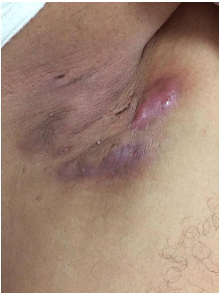 This clinical photograph displays a close-up view of the human axilla demonstrating signs of Hidradenitis Suppurativa (HS). The primary findings are multiple erythematous, inflamed lumps and deep-seated nodules. The largest lesion is a prominent, elongated, reddish-pink nodule with a shiny, tense surface, suggesting acute inflammation or early abscess formation. Below it, a linear, dusky-purple area indicates chronic inflammatory activity, possible sinus tract formation, and underlying fibrosis. The surrounding skin shows post-inflammatory hyperpigmentation, particularly within the skin folds, and textural irregularities consistent with scarring from previous flare-ups. A few scattered small, inflammatory papules are also visible in the periphery. This image illustrates the characteristic distribution of HS in intertriginous areas where apocrine glands are concentrated, highlighting the progression from acute nodules to chronic scarring and disfigurement, which is essential for clinical staging (Hurley criteria) and diagnostic classification in dermatology.